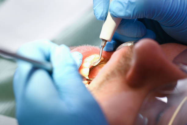 Best Emergency Dentist for Knocked-Out Tooth in Joppatowne, MD