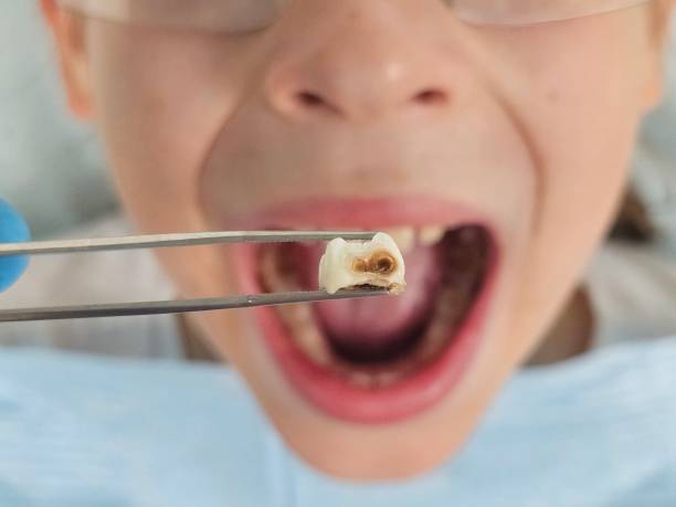 Best Broken or Cracked Tooth Emergency Dentist in Joppatowne, MD