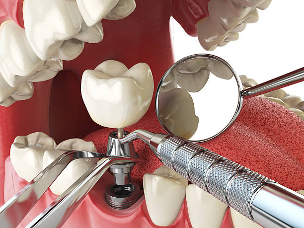 Best Emergency Dental Extractions in Joppatowne, MD